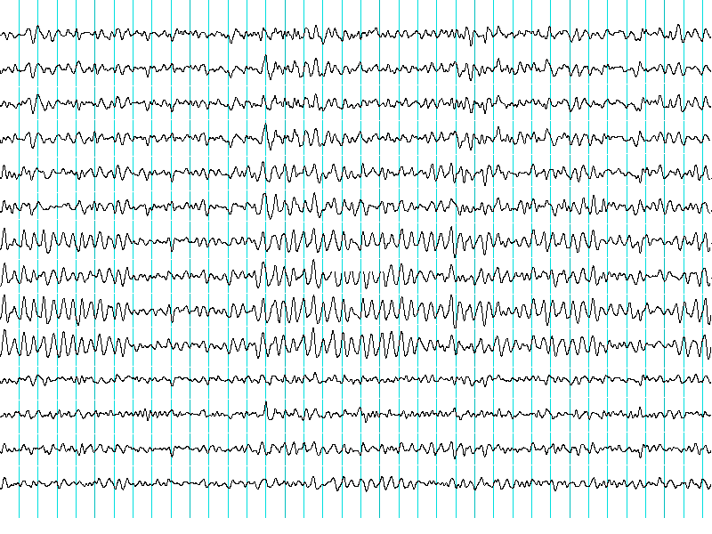 Epilepsia-crisis-convulsivas-convulsiones-NeuroClass