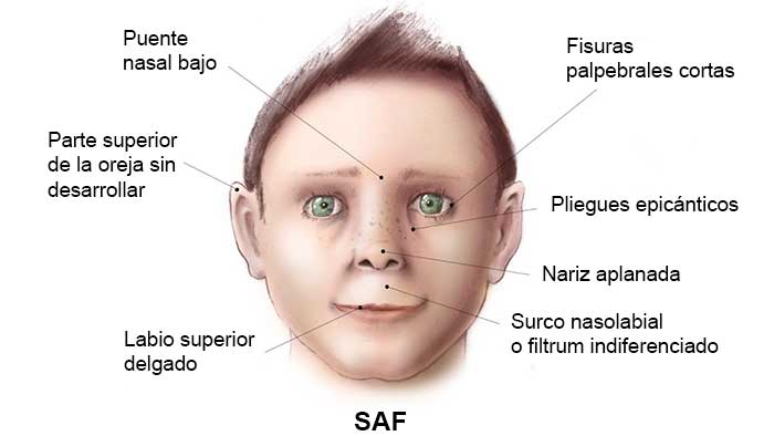 Síndrome alcohólico fetal NeuroClass