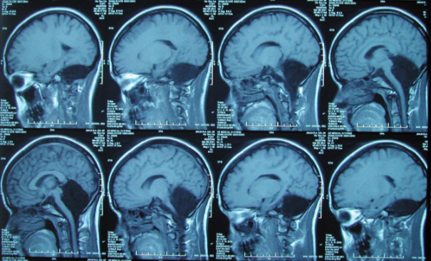 Vivir sin cerebelo y funcionamiento del cerebelo