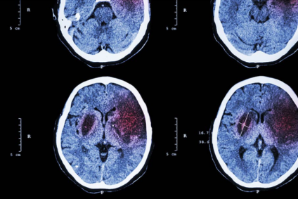 ictus y linfoma diferencia