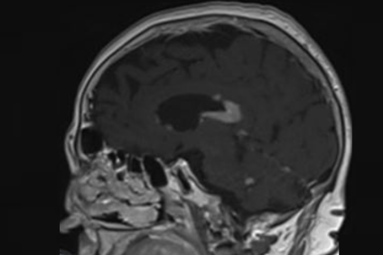 que es un linfoma cerebral